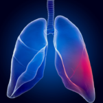 pneumologista do hospital de messejana detalha sintomas e tratamento da fibrose pulmonar