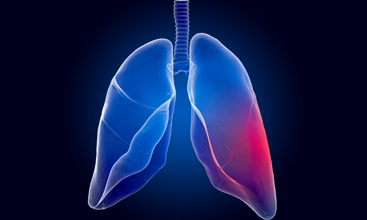 pneumologista do hospital de messejana detalha sintomas e tratamento da fibrose pulmonar